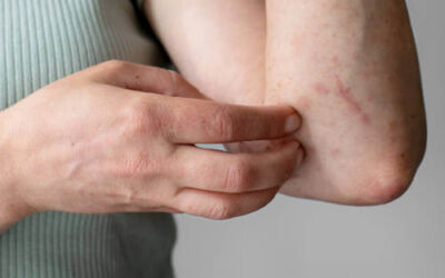 Diferencias entre picaduras de pulgas, chinches o mosquitos